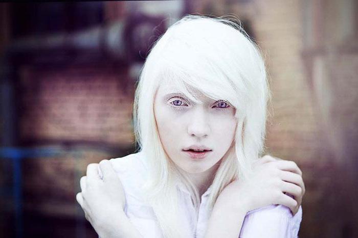 Albinism