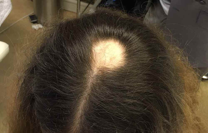 Alopecia Areata