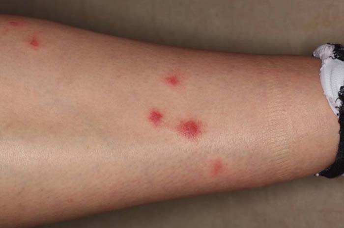 Cutaneous Reactions to Arthropod Bites