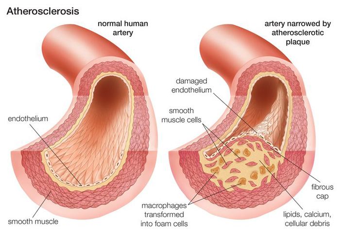 Atherosclerosis