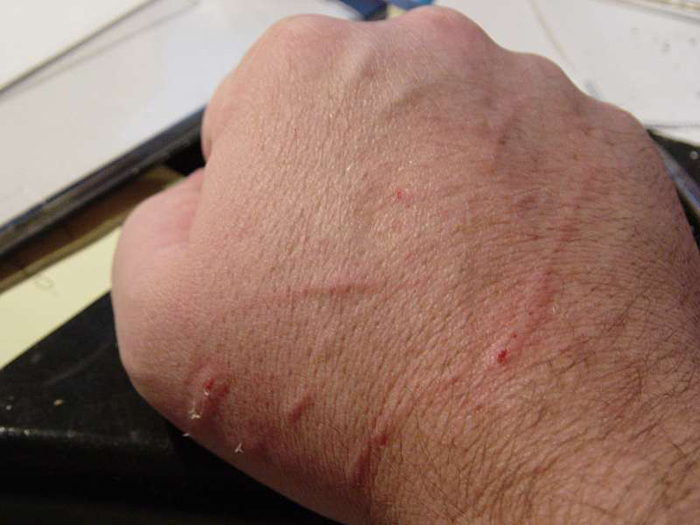 Cat Scratch Disease Causes Symptoms And Treatment