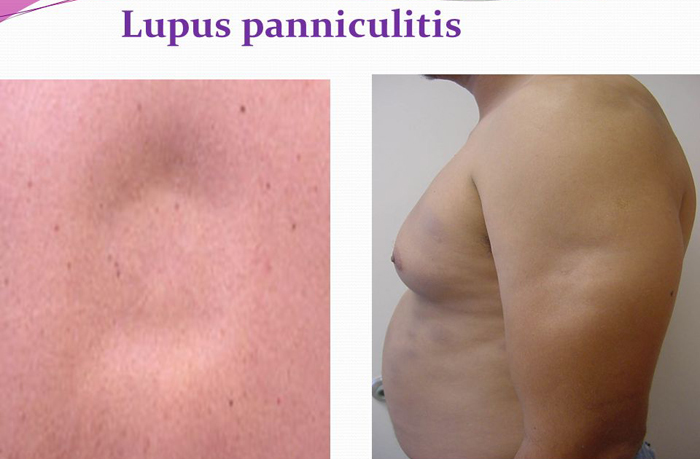 Chronic Lupus Panniculitis