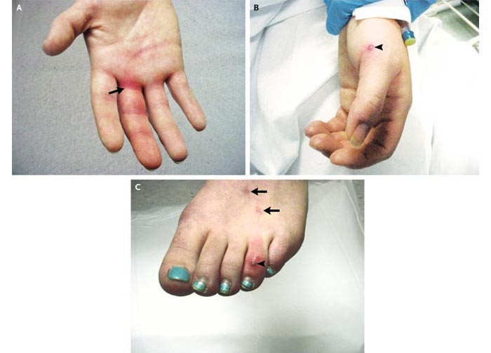 Disseminated Gonococcal Infection