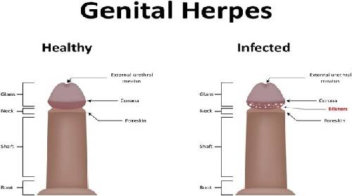 Herpes Simplex Virus: Genital Infections