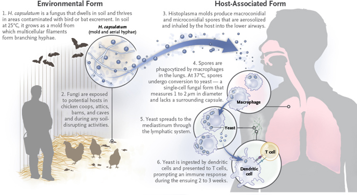 Histoplasmosis