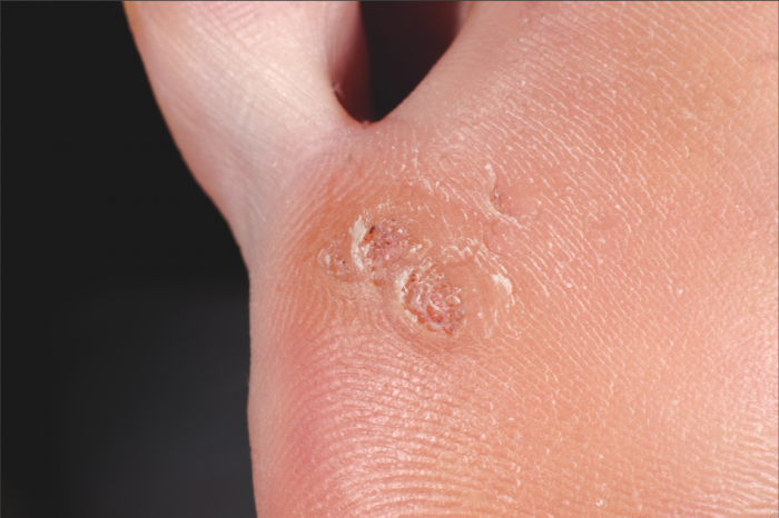 Hpv warts under skin - Papillomavirus skin warts