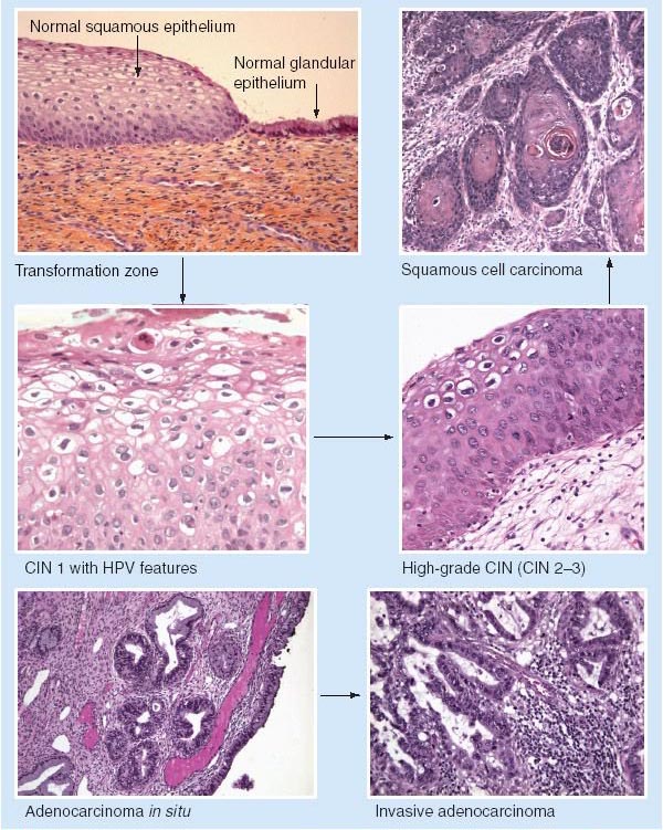 Human Papillomavirus: Squamous Cell Carcinoma In Situ