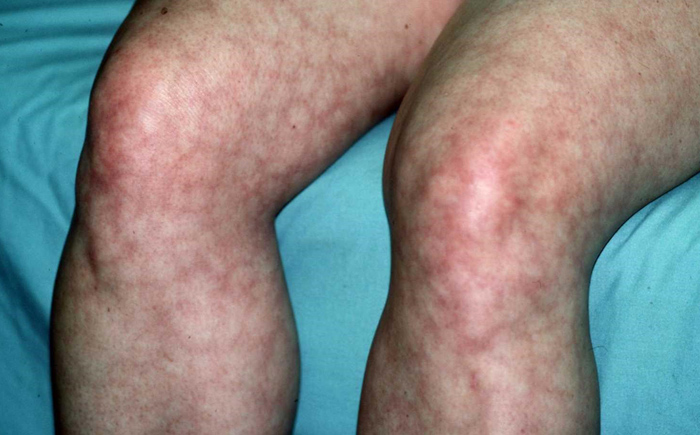 Livedo Reticularis - Skin Disorders