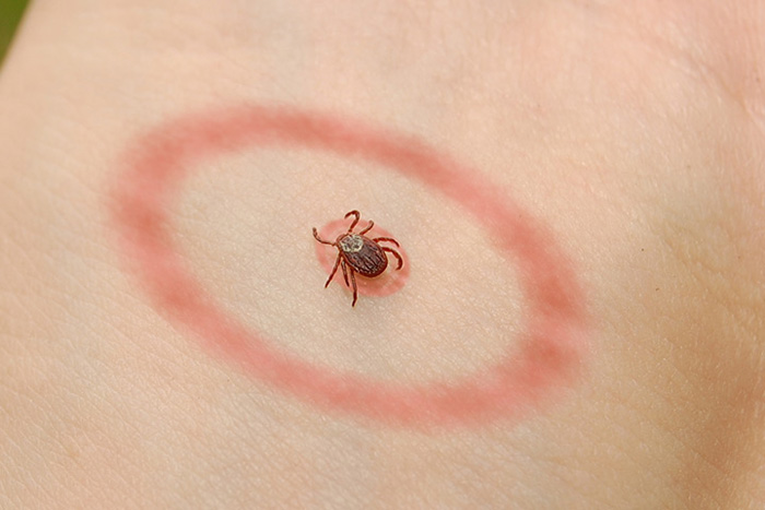 Lyme Borreliosis Causes Symptoms And Treatment