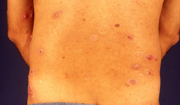 Lymphomatoid Papulosis