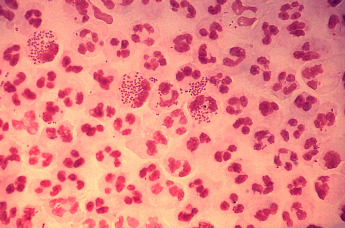 Neisseria Gonorrhoeae Infections