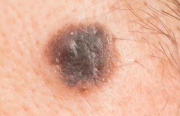 Nodular Melanoma