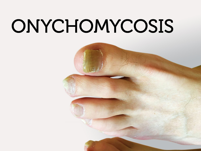 Onychomycosis