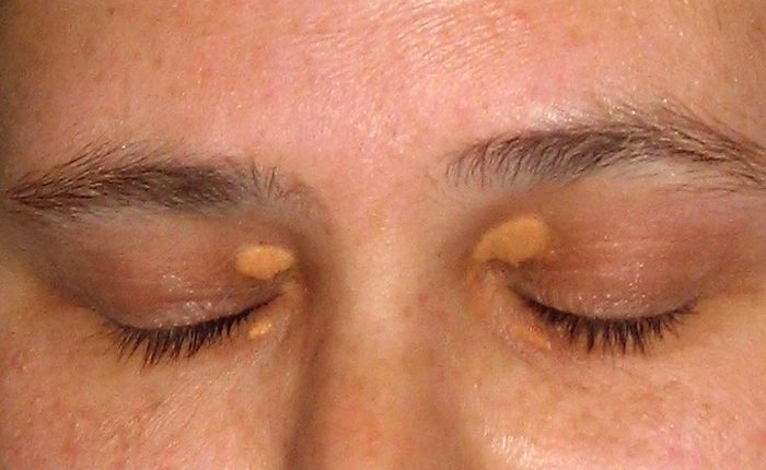 Xanthelasma