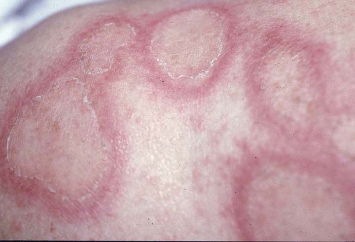 Cutaneous Lupus Erythematosus