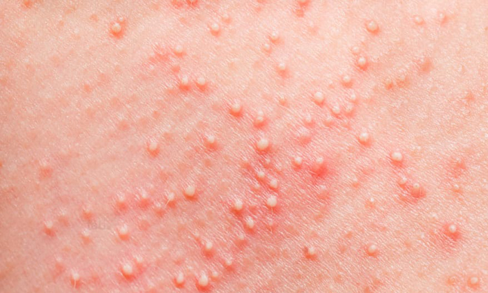 Infectious Folliculitis