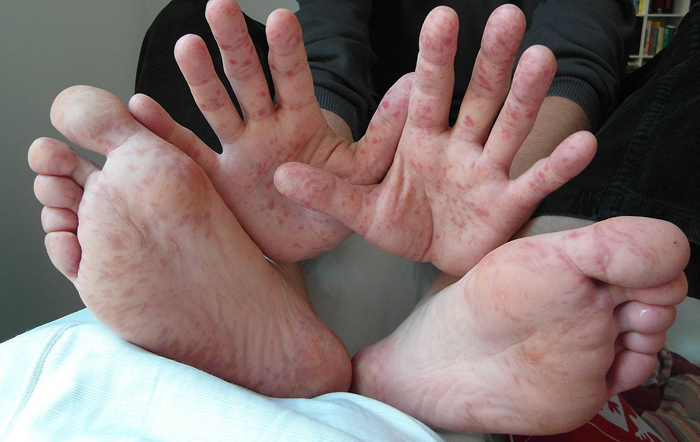 Hand Foot Disease