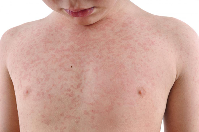 Rubella (German Measles)