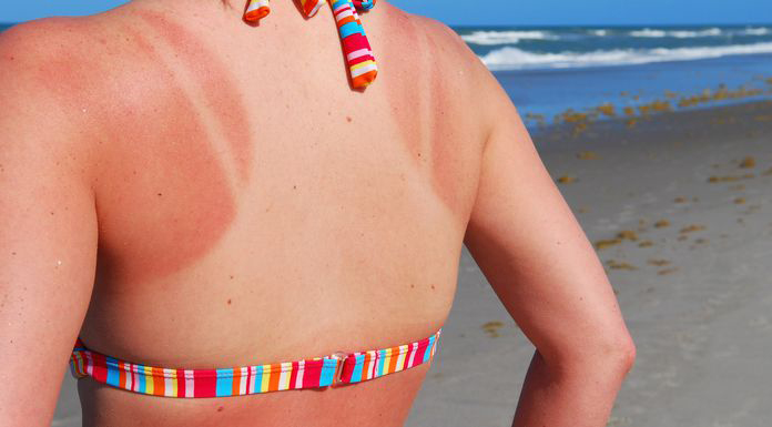 Acute Sun Damage (Sunburn)