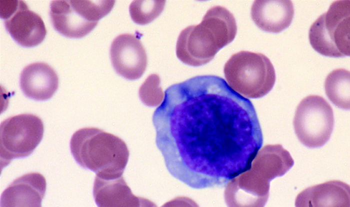 Adult T Cell Leukemia/Lymphoma
