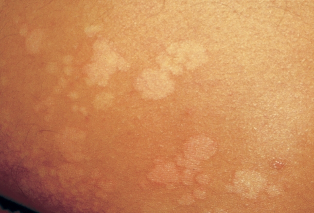 Pityriasis Versicolor Causes Symptoms And Treatment