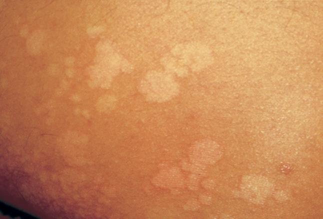 Pityriasis Versicolor