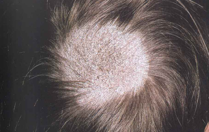 Tinea Capitis