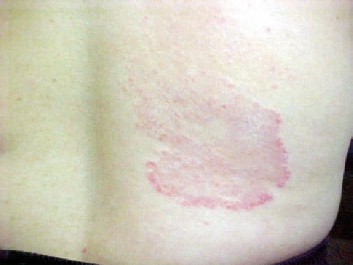 Tinea Corporis On Legs