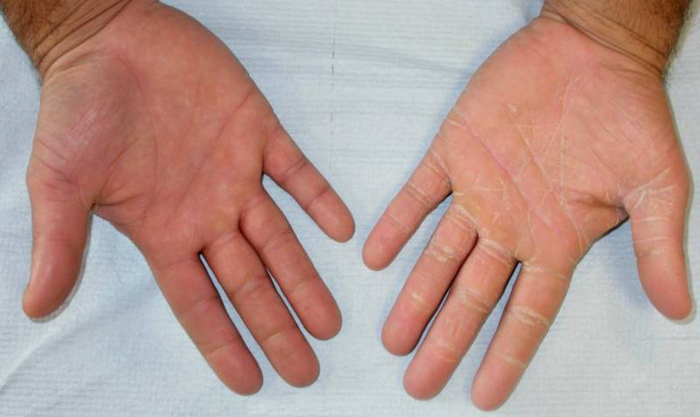Tinea Versicolor Hands