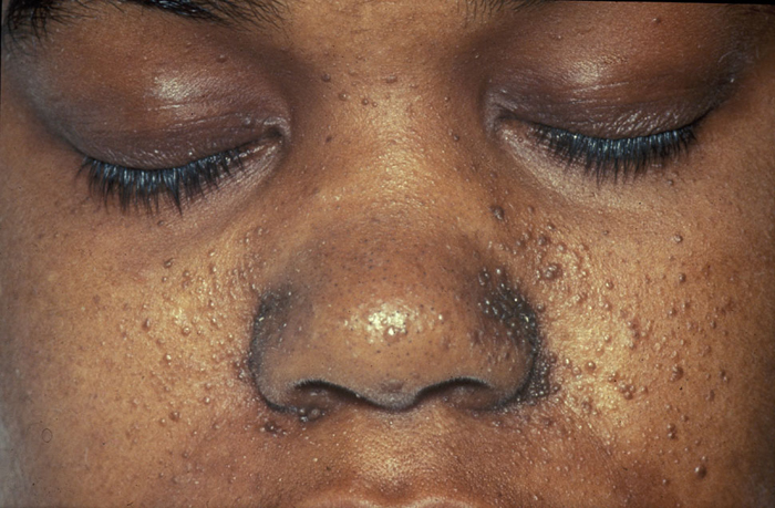 Tuberous Sclerosis