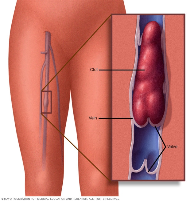 Thrombophlebitis and Deep Venous Thrombosis