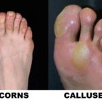 Corns And Calluses