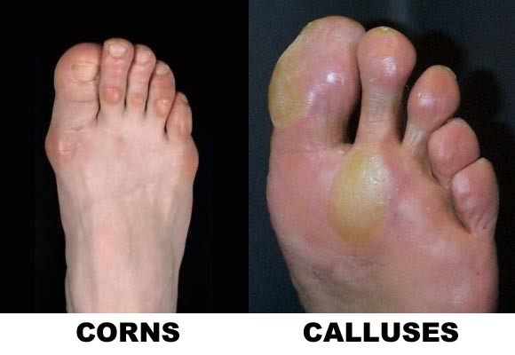 Corns And Calluses